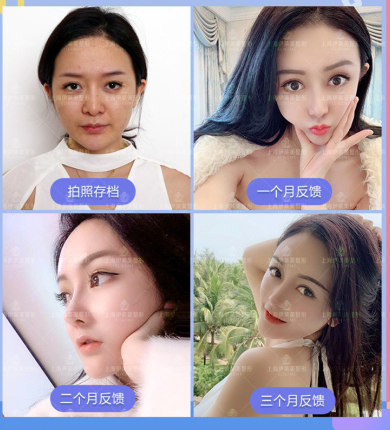 錢玉鑫肋骨鼻綜合案例