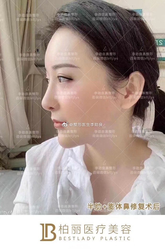李勁良肋骨鼻案例
