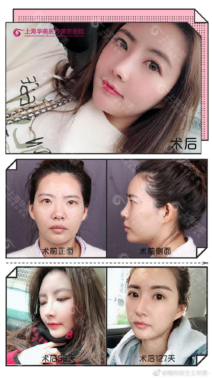 王榮錫面部填充案例
