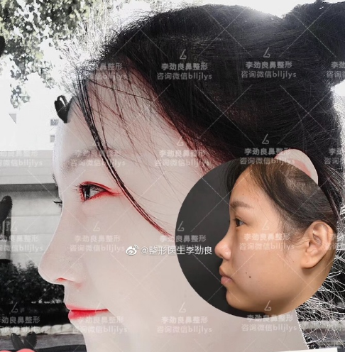 李勁良鼻綜合案例