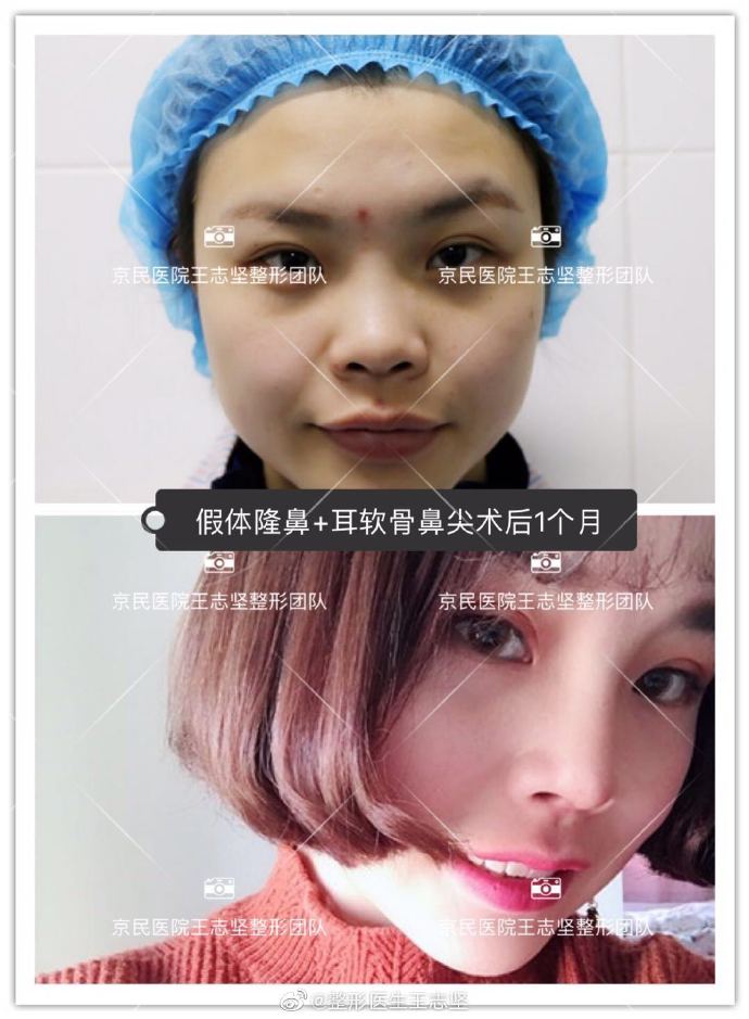 王志堅鼻綜合案例