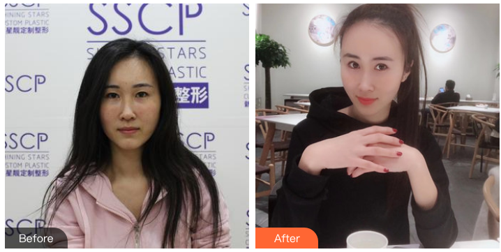 成鋌鼻綜合案例