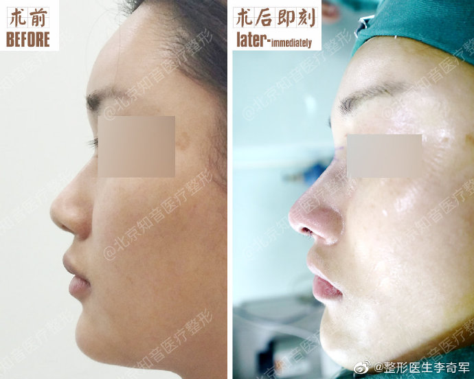 李奇軍鼻綜合案例