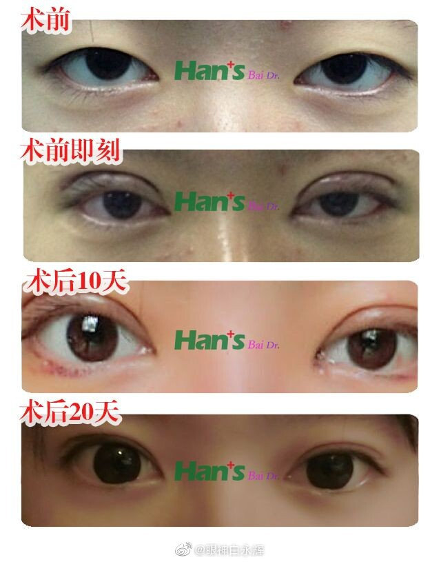 白永輝雙眼皮案例