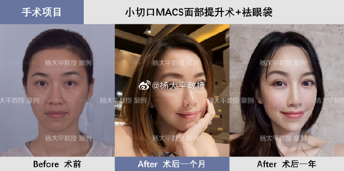 楊大平拉皮案例