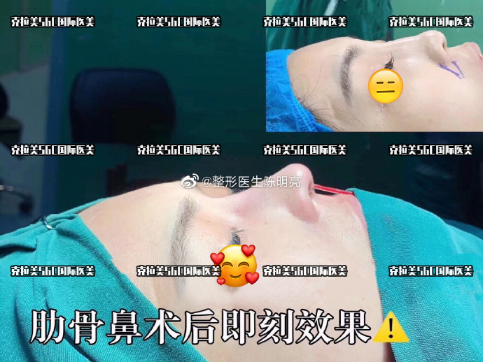 陳明亮鼻整形案例
