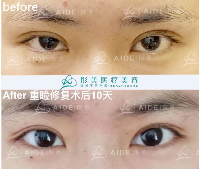 劉風卓眼修復案例