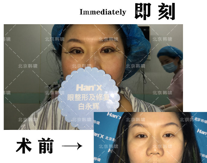 白永輝雙眼皮修復(fù)案例