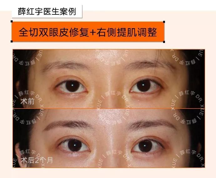 薛紅宇雙眼皮修復(fù)案例