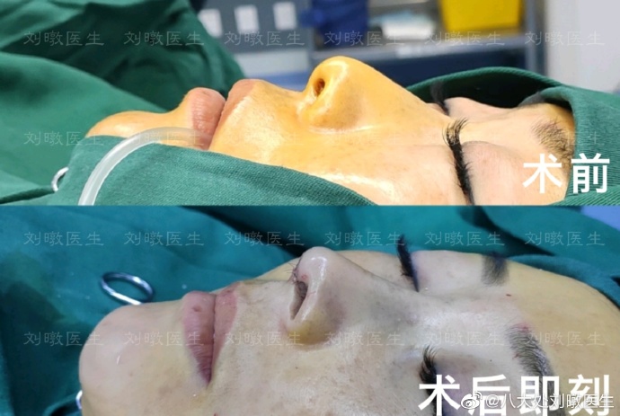 劉暾鼻修復(fù)案例