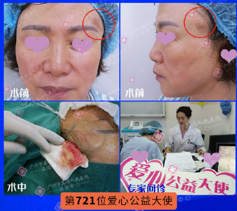 鄧正軍奧美定取出案例