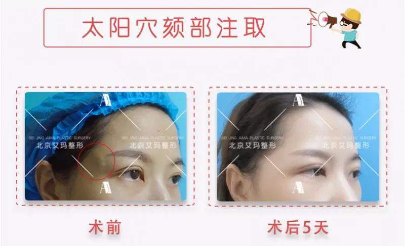 丁小邦?yuàn)W美定取出案例