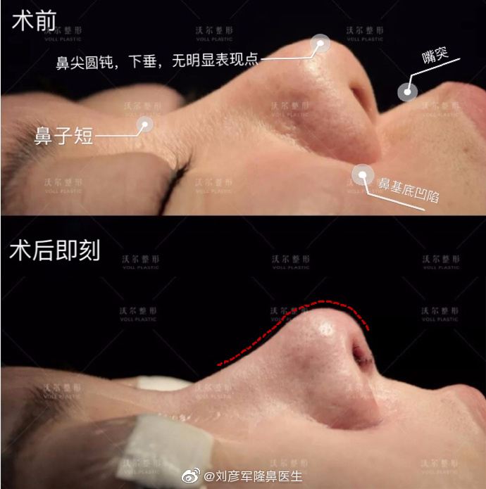 劉彥軍隆鼻案例