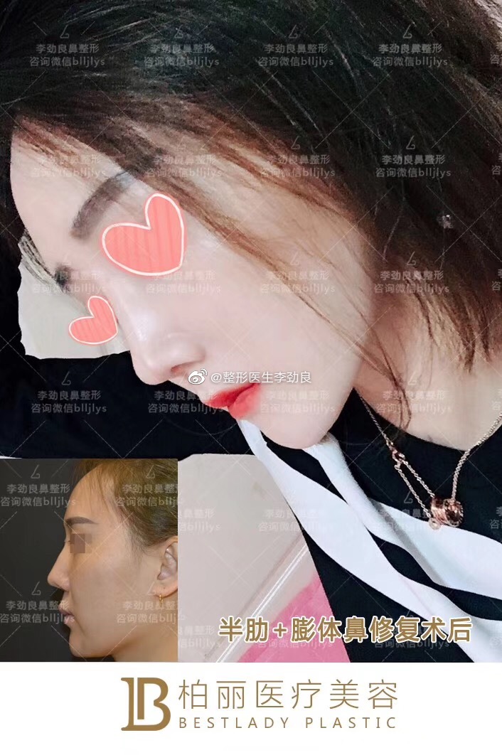 李勁良隆鼻案例