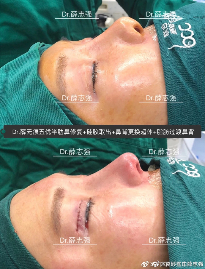 薛志強鼻綜合案例