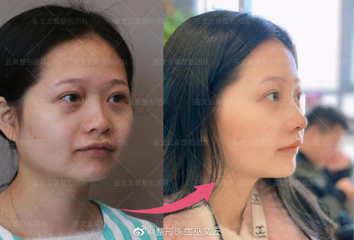 巫文云鼻修復案例