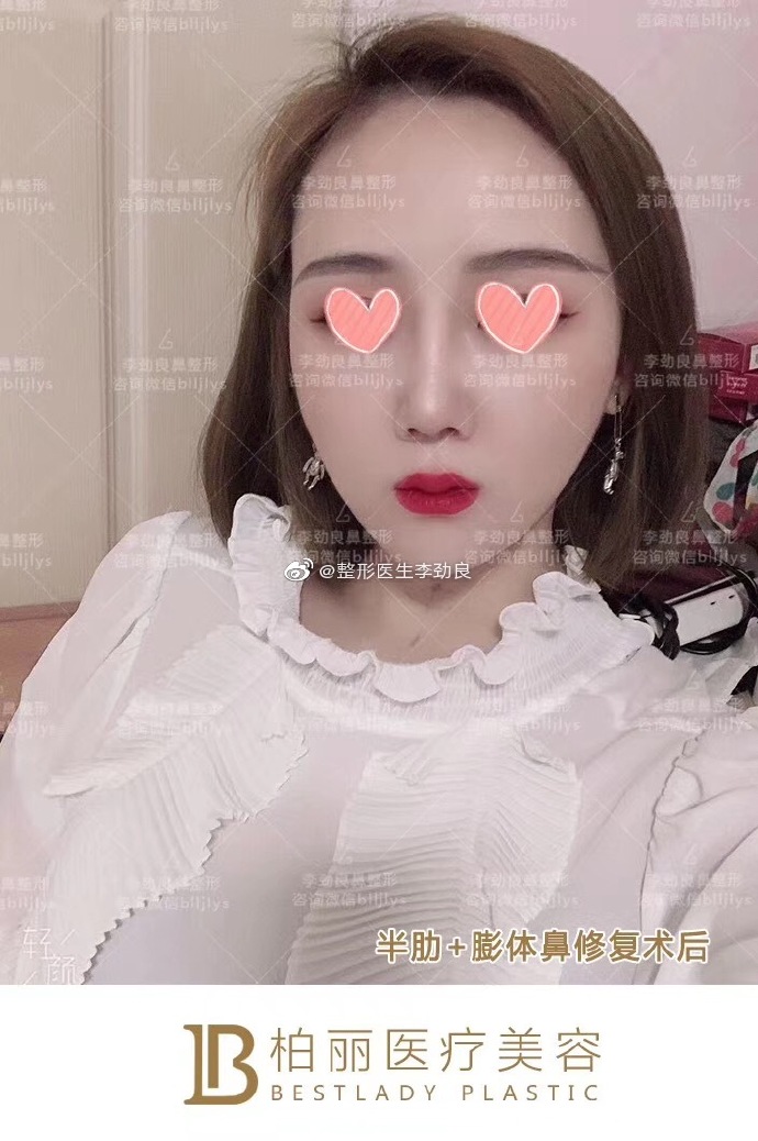 李勁良鼻修復案例