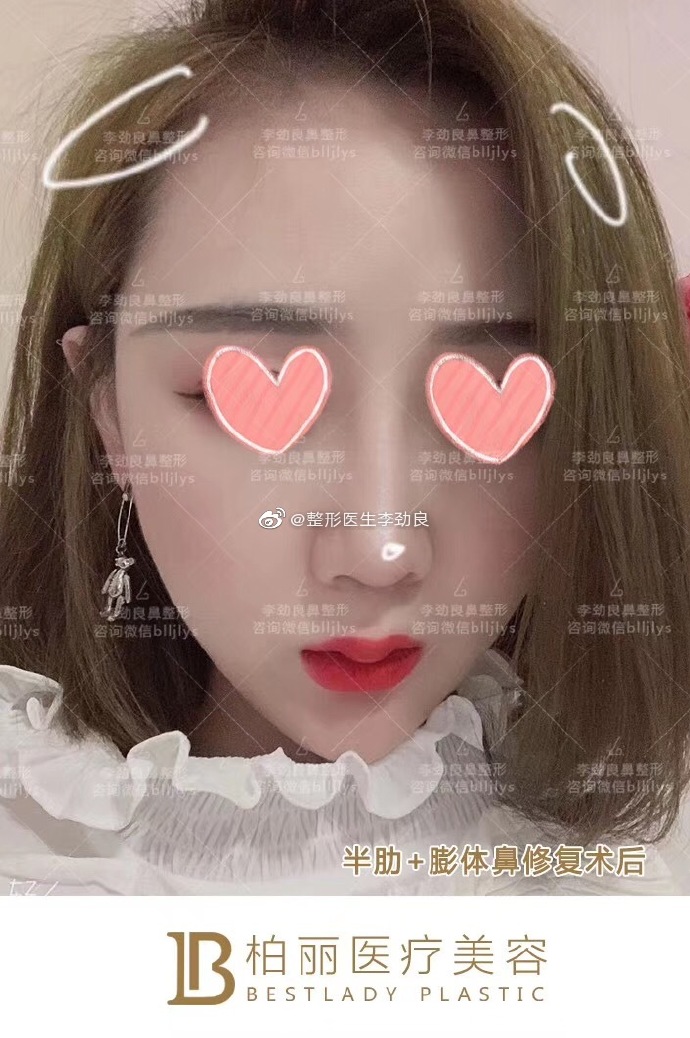 李勁良鼻修復案例