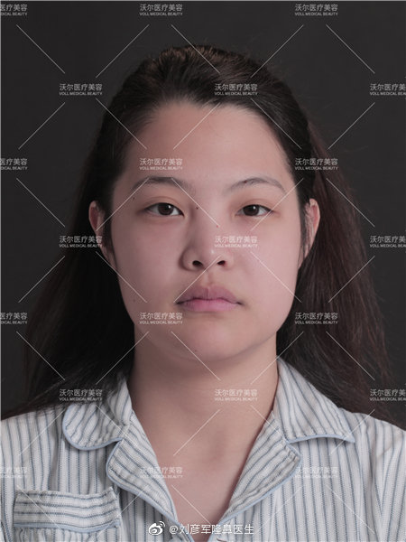 劉彥軍鼻修復案例