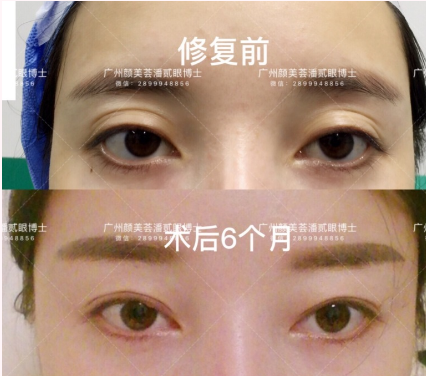 潘貳眼修復案例