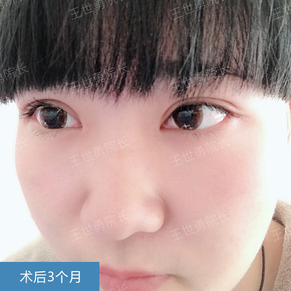 王世勇眼修復案例