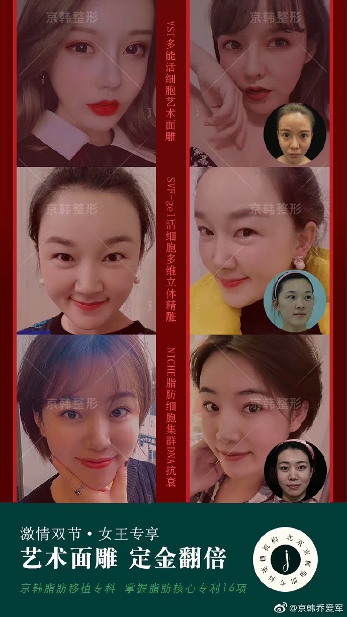 喬愛軍脂肪填充案例