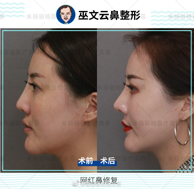 巫文云鼻修復案例