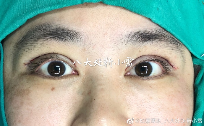 靳小雷雙眼皮修復案例