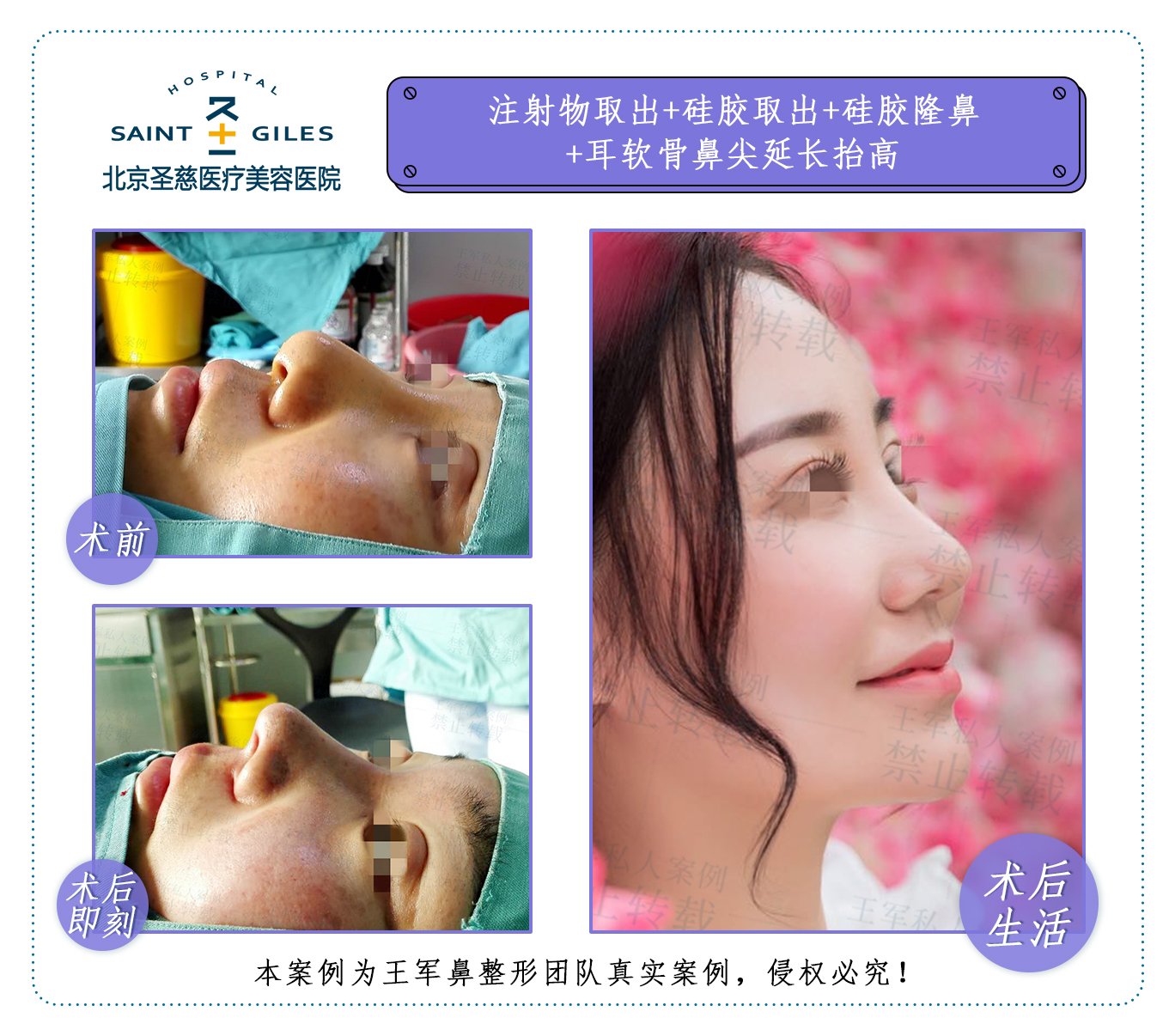 王軍鼻修復案例