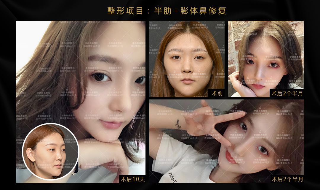 李勁良鼻修復案例
