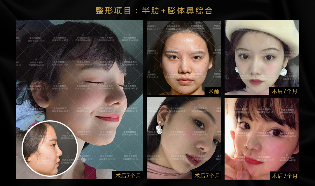 李勁良鼻修復案例