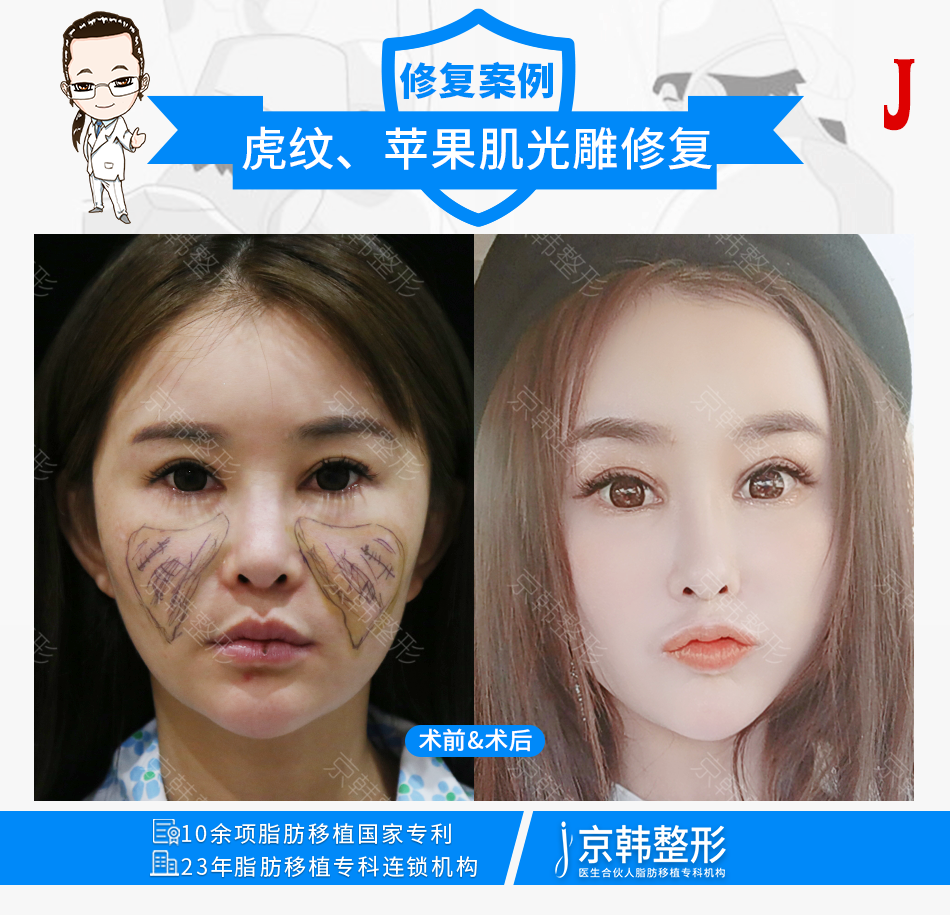 喬愛軍脂肪修復(fù)案例