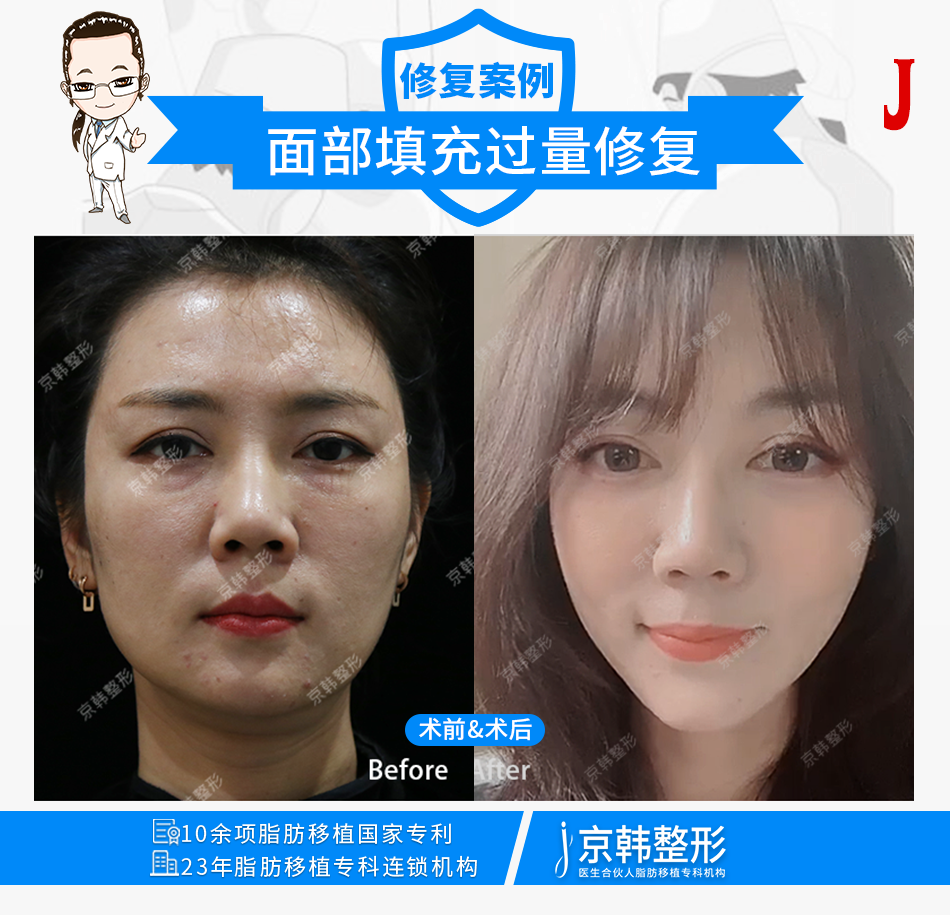 喬愛軍脂肪修復(fù)案例