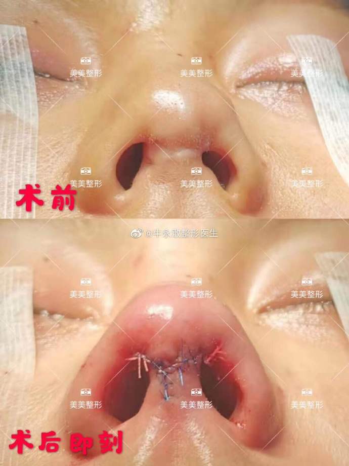 牛勇敢鼻修復案例