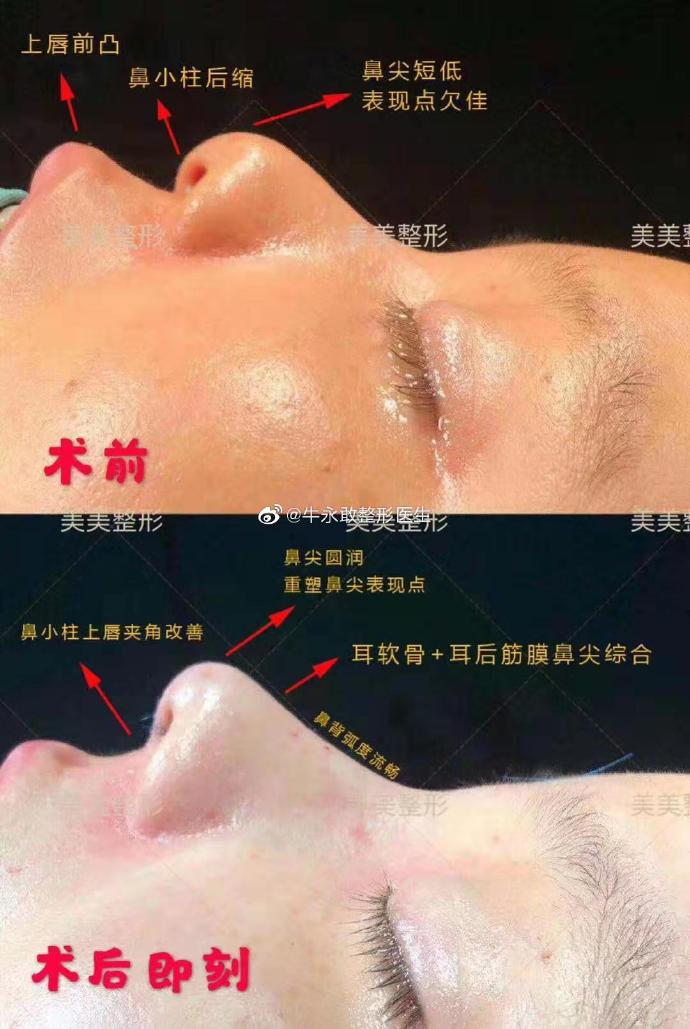 牛勇敢鼻綜合案例