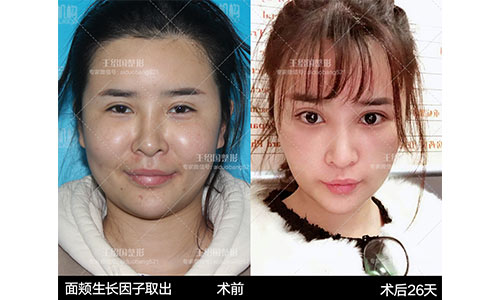 王紹國取生長因子案例