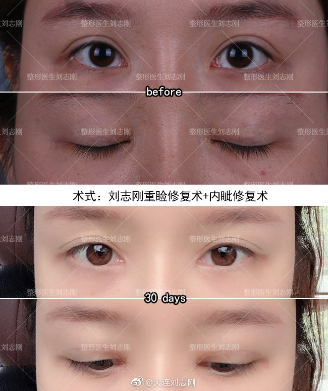 劉志剛眼修復案例