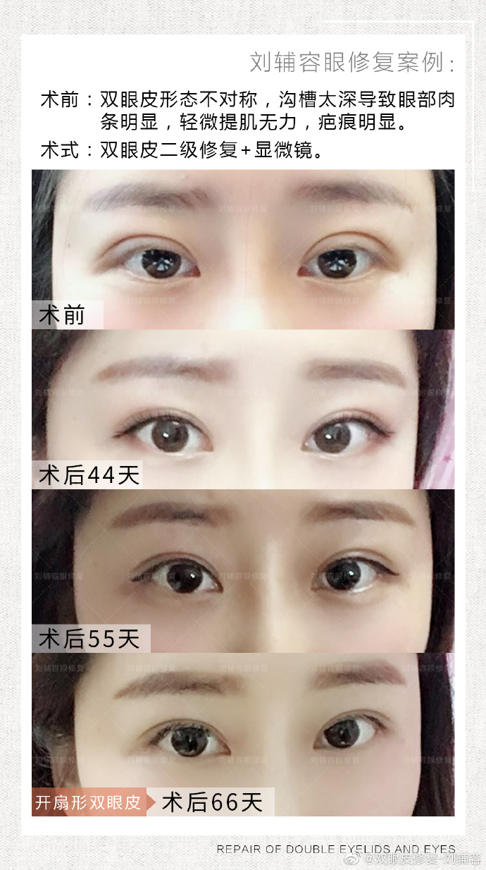 劉輔容眼修復案例