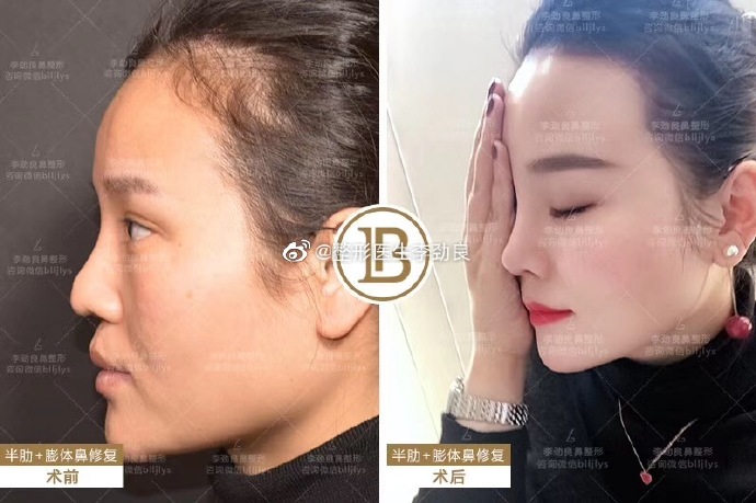 李勁良鼻修復案例