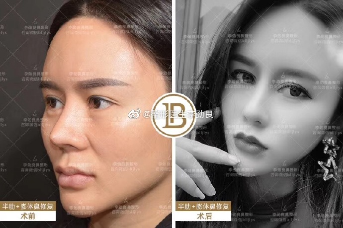 李勁良鼻修復案例