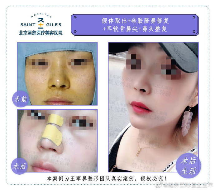 王軍鼻修復案例