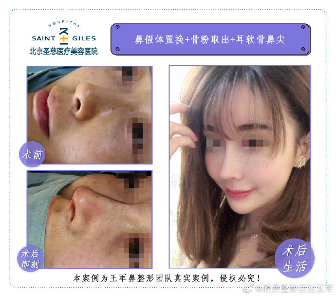 王軍鼻修復案例