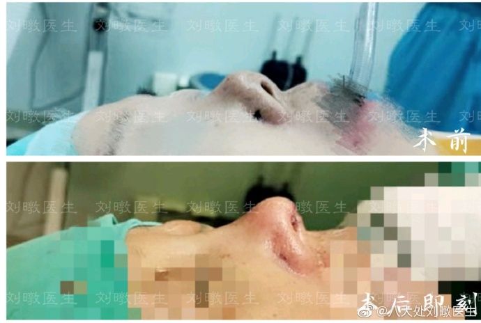 劉暾鼻綜合案例