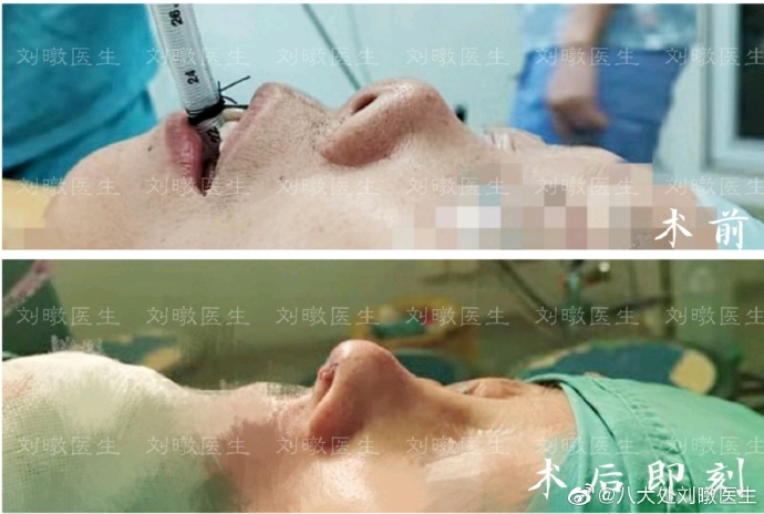 劉暾鼻綜合案例