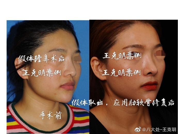 王克明鼻綜合案例