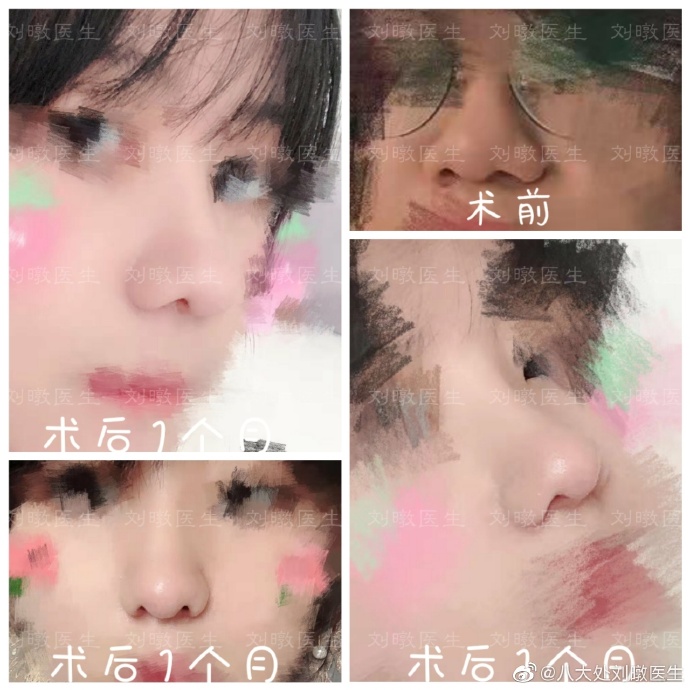 劉暾鼻綜合案例