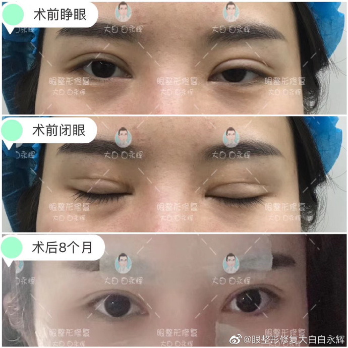 白永輝雙眼皮修復案例