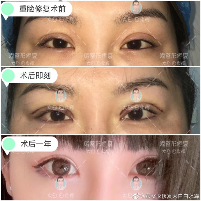 白永輝雙眼皮修復案例
