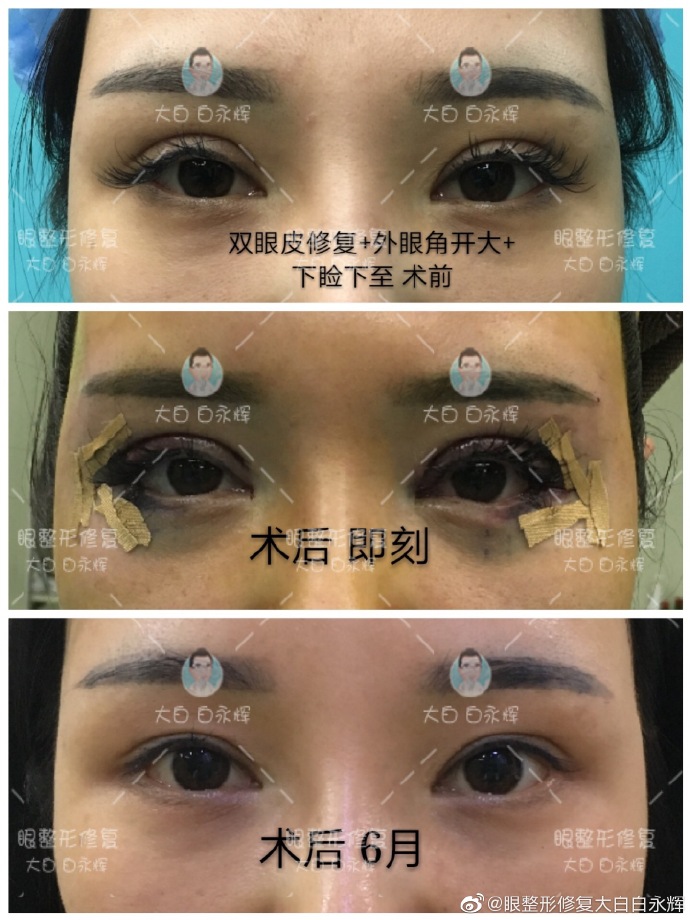 白永輝雙眼皮修復案例