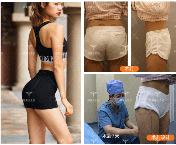 王明利脂肪豐臀案例